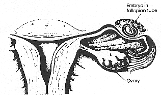 uterus with embryo implanted in fallopian tube