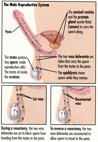 vasectomy