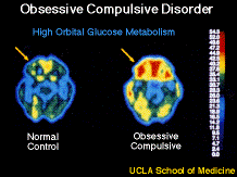 brain scan of OCD